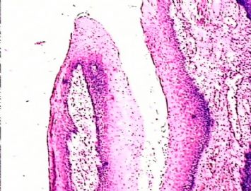 乳头状病变，判断良恶性图1