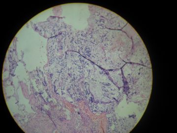 请教诊断：胆囊底胶冻样新生物图1