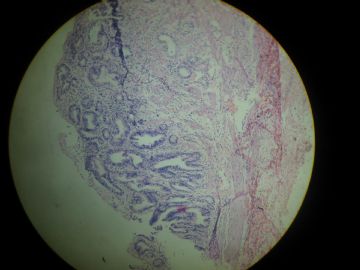 请教诊断：胆囊底胶冻样新生物图5