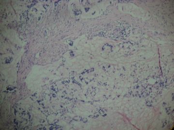 请教诊断：胆囊底胶冻样新生物图10