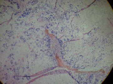 请教诊断：胆囊底胶冻样新生物图11