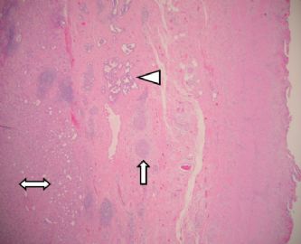 educational case---rare gallbladder tumor图1