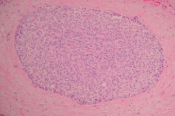 educational case---rare gallbladder tumor图2