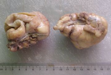 双侧卵巢肿瘤一例图1