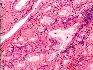 胆囊底的肿物，临床诊断胆囊癌图8