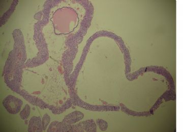 膀胱菜花状肿物一个2cm×1.2cm×0.5cm图5