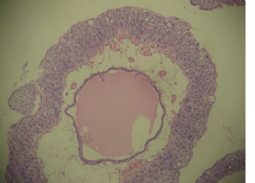 膀胱菜花状肿物一个2cm×1.2cm×0.5cm图6