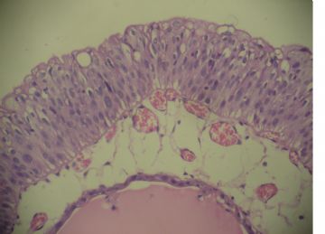 膀胱菜花状肿物一个2cm×1.2cm×0.5cm图7