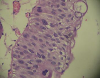 膀胱菜花状肿物一个2cm×1.2cm×0.5cm图8