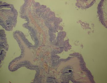 膀胱菜花状肿物一个2cm×1.2cm×0.5cm图13