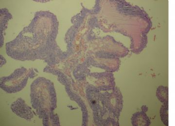 膀胱菜花状肿物一个2cm×1.2cm×0.5cm图14