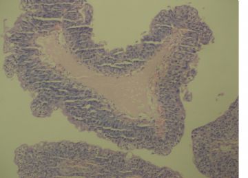膀胱菜花状肿物一个2cm×1.2cm×0.5cm图16