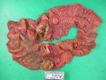 Chest wall mass with small bowel and colon meta图1