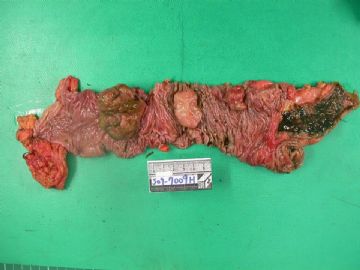 Chest wall mass with small bowel and colon meta图2