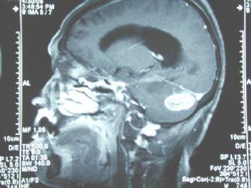 左小脑半球肿瘤图1