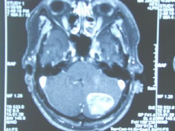 左小脑半球肿瘤图2
