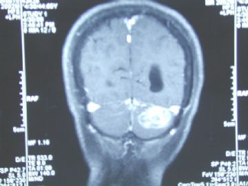 左小脑半球肿瘤图3