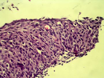宫颈是鳞状化生吗？图10