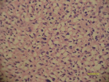 最近看到的胃间质瘤~梭形细胞和上皮样细胞混合型~~图1