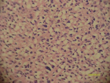 最近看到的胃间质瘤~梭形细胞和上皮样细胞混合型~~图2