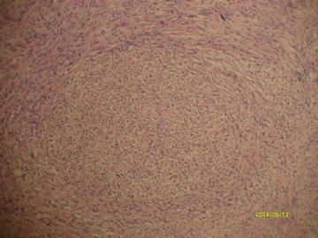 最近看到的胃间质瘤~梭形细胞和上皮样细胞混合型~~图3