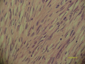 最近看到的胃间质瘤~梭形细胞和上皮样细胞混合型~~图4