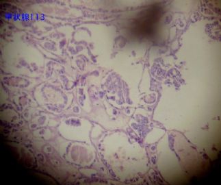 甲状腺肿物，够癌吗，请老师会诊，急图22