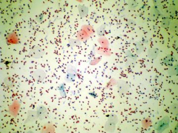 液基－嗜酸性粒细胞图1