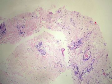 44岁，乳腺肿物穿刺图1