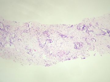 44岁，乳腺肿物穿刺图2