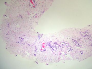 44岁，乳腺肿物穿刺图3