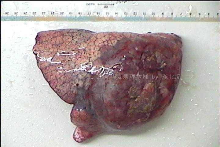 右肺下叶肿物（急需回复！！！）图1