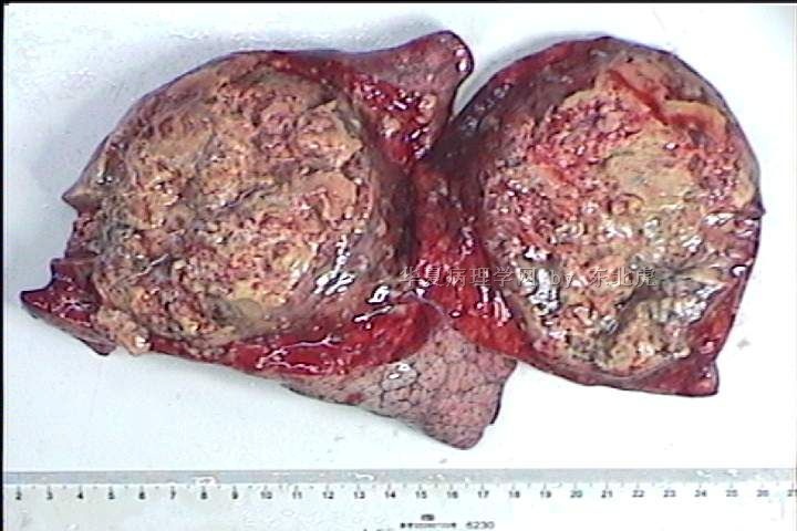 右肺下叶肿物（急需回复！！！）图2