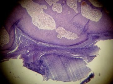 一例罕见的皮肤病理，请各位老师给于诊断，上传病理切图3