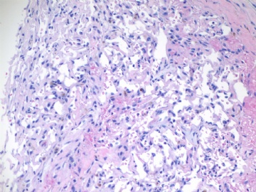 乳房不典型血管瘤( cqz-20)图2