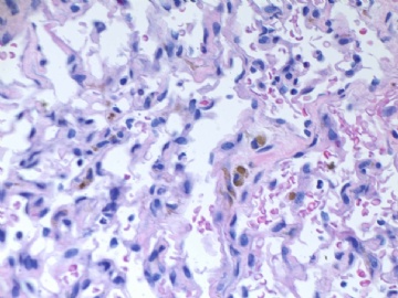 乳房不典型血管瘤( cqz-20)图4
