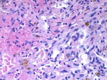 乳房不典型血管瘤( cqz-20)图5