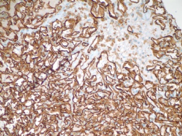 乳房不典型血管瘤( cqz-20)图6