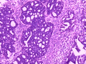 卵巢肿瘤图2