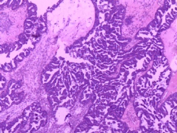 卵巢肿瘤图3