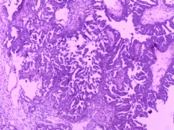 卵巢肿瘤图6