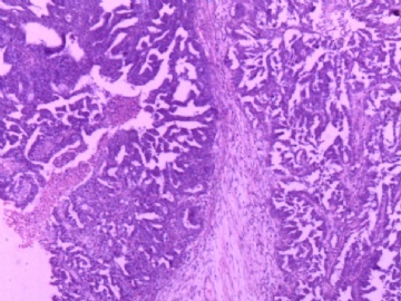 卵巢肿瘤图8