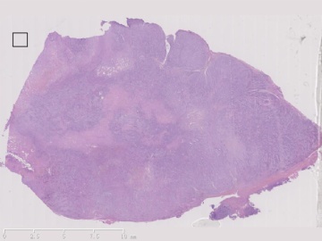 甲状腺肿物图1