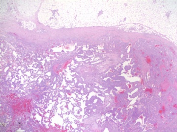 乳房高级别血管肉瘤(cqz-22)图2