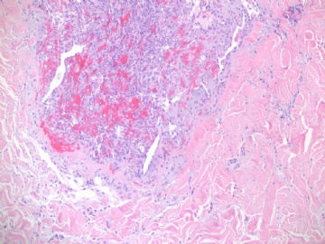 乳房高级别血管肉瘤(cqz-22)图3