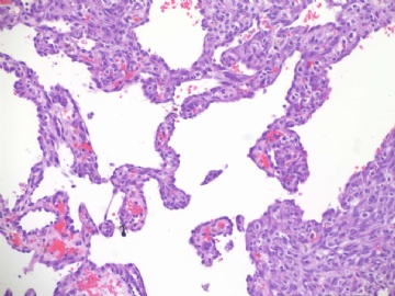 乳房高级别血管肉瘤(cqz-22)图4