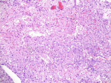 乳房高级别血管肉瘤(cqz-22)图5