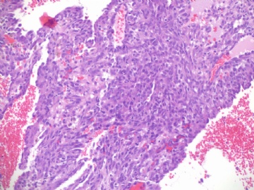 乳房高级别血管肉瘤(cqz-22)图6