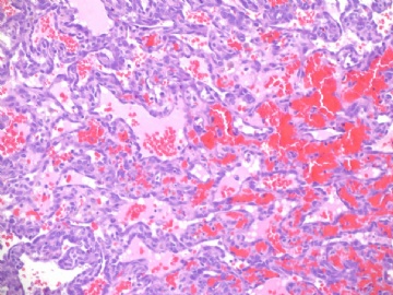 乳房高级别血管肉瘤(cqz-22)图7