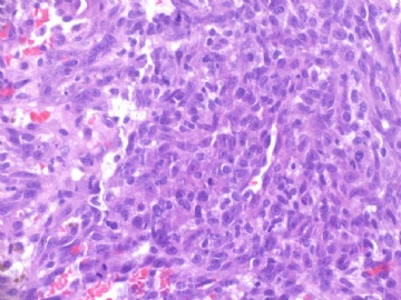 乳房高级别血管肉瘤(cqz-22)图8